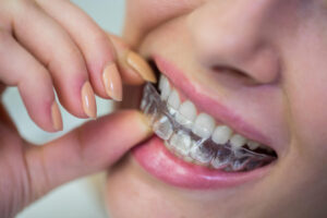 Mulher usa os dedos para encaixar alinhadores invisíveis nos dentes superiores na Clínica Herrera Prime em São José dos Campos.