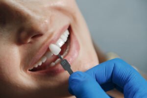 Dentista com luva azul usa escala B1 para selecionar a cor de facetas em resina em São José dos Campos na Clínica Herrera Prime.